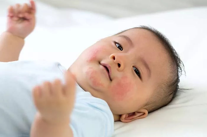 Memahami Scabies pada Bayi: Gejala, Penyebab, dan Perawatan yang Diperlukan