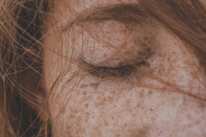 Mengenal Freckles: Antara Genetika, Gaya Hidup, dan Paparan UV
