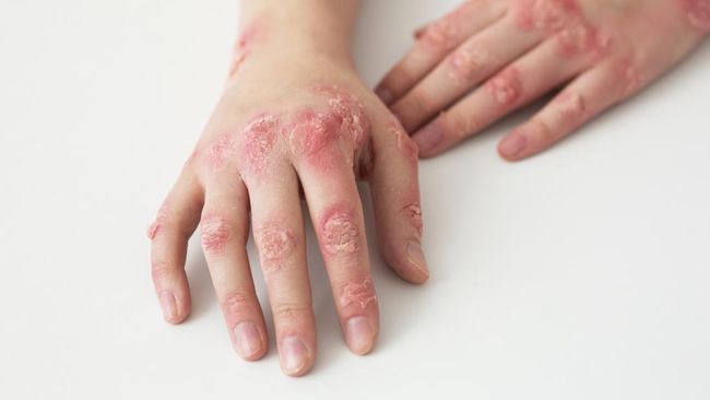 Mengungkap Berbagai Penyebab Herpes yang Perlu Diketahui