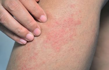 Kulit Kering dan Gatal Terus? Ini Penyebab yang Sering Diabaikan