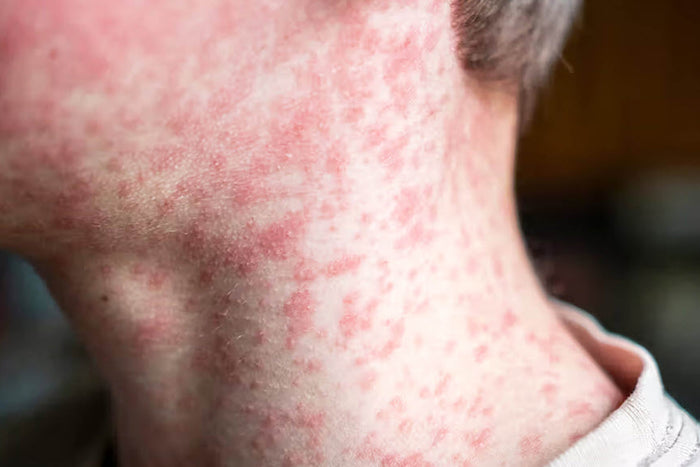 Bukan Sekadar Ruam! Kenali Campak dan Bahayanya