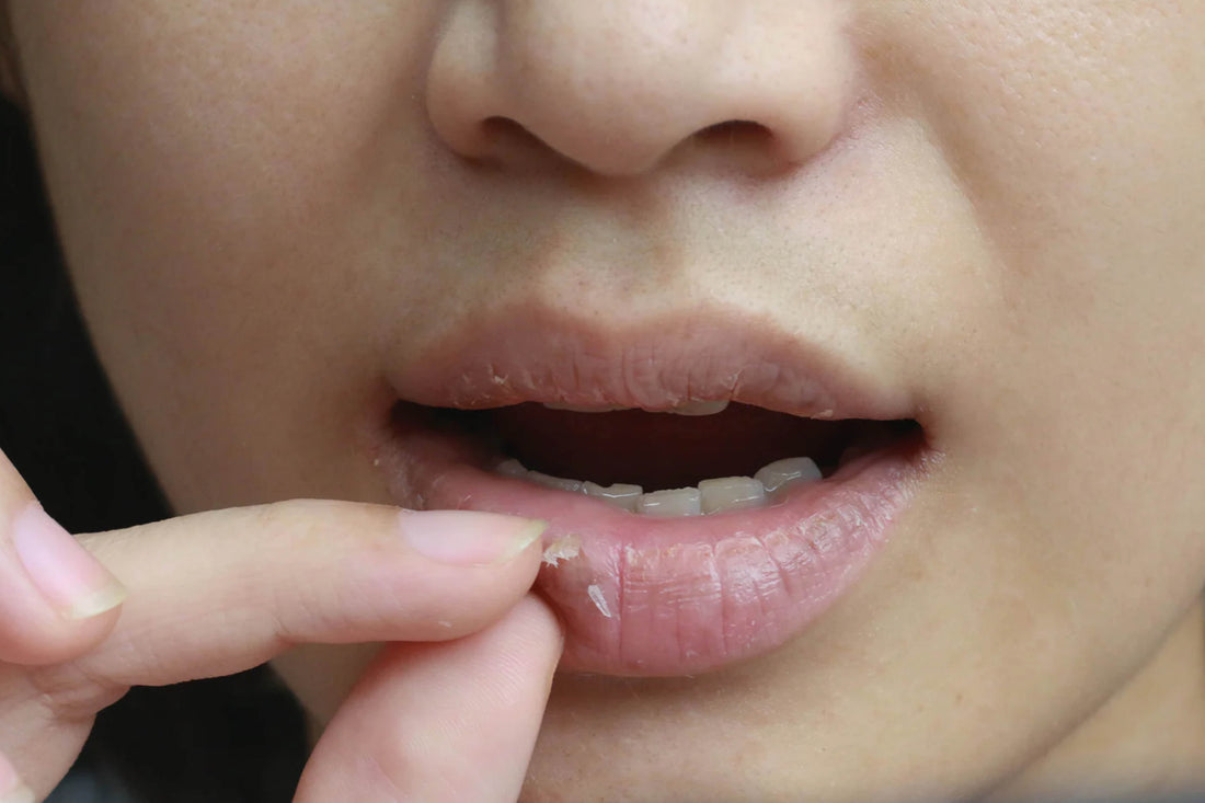 Mengopet Bibir: Kebiasaan Ringan yang Bisa Jadi Masalah Serius