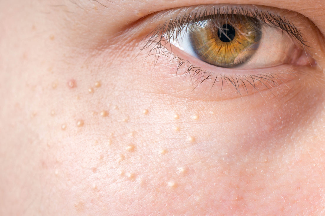 Milia pada Wajah: Apakah Berbahaya dan Kapan Harus ke Dokter?