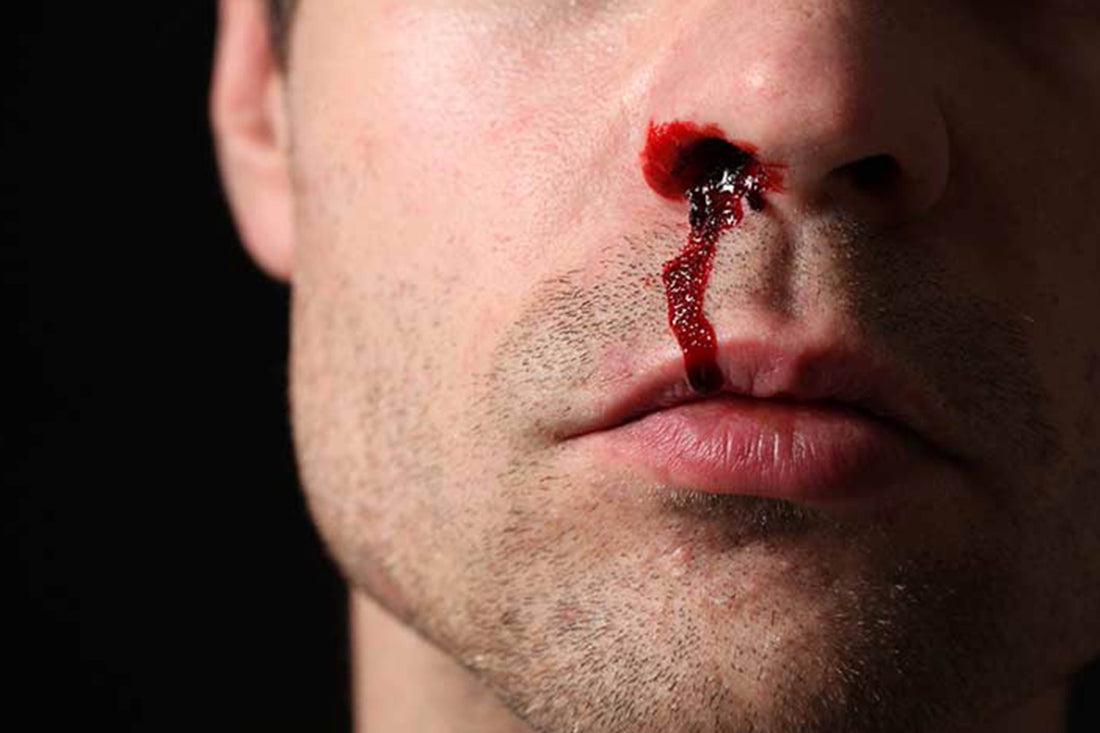 Jangan Anggap Sepele Mimisan yang Terjadi Berulang