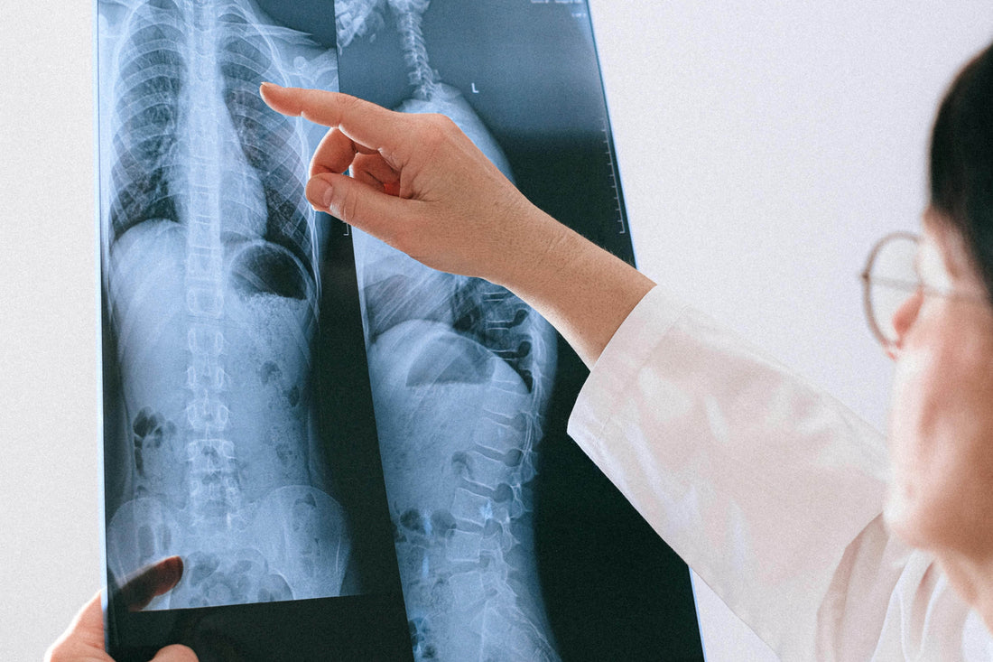 Dari Ringan hingga Berat: Seberapa Jauh Skoliosis Bisa Diperbaiki?