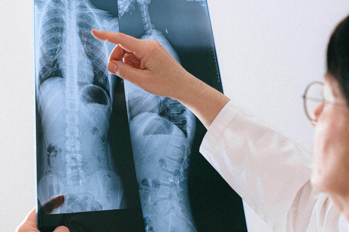 Dari Ringan hingga Berat: Seberapa Jauh Skoliosis Bisa Diperbaiki?