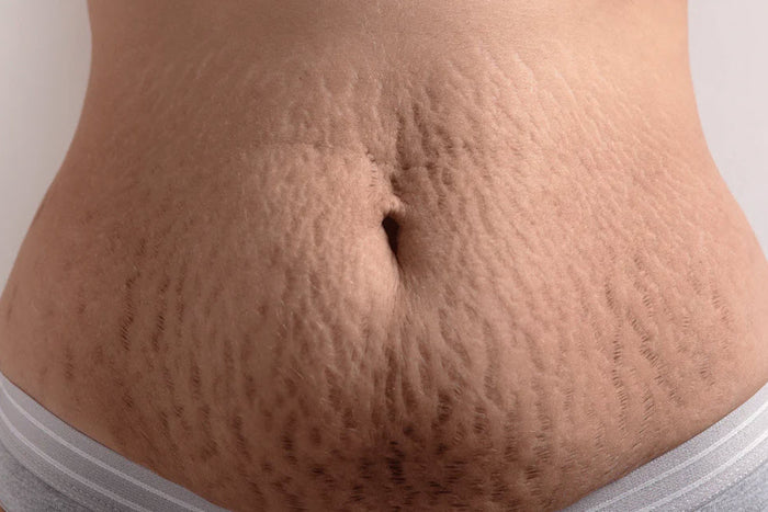 Stretch Mark: Musuh atau Sahabat Perubahan Tubuh?