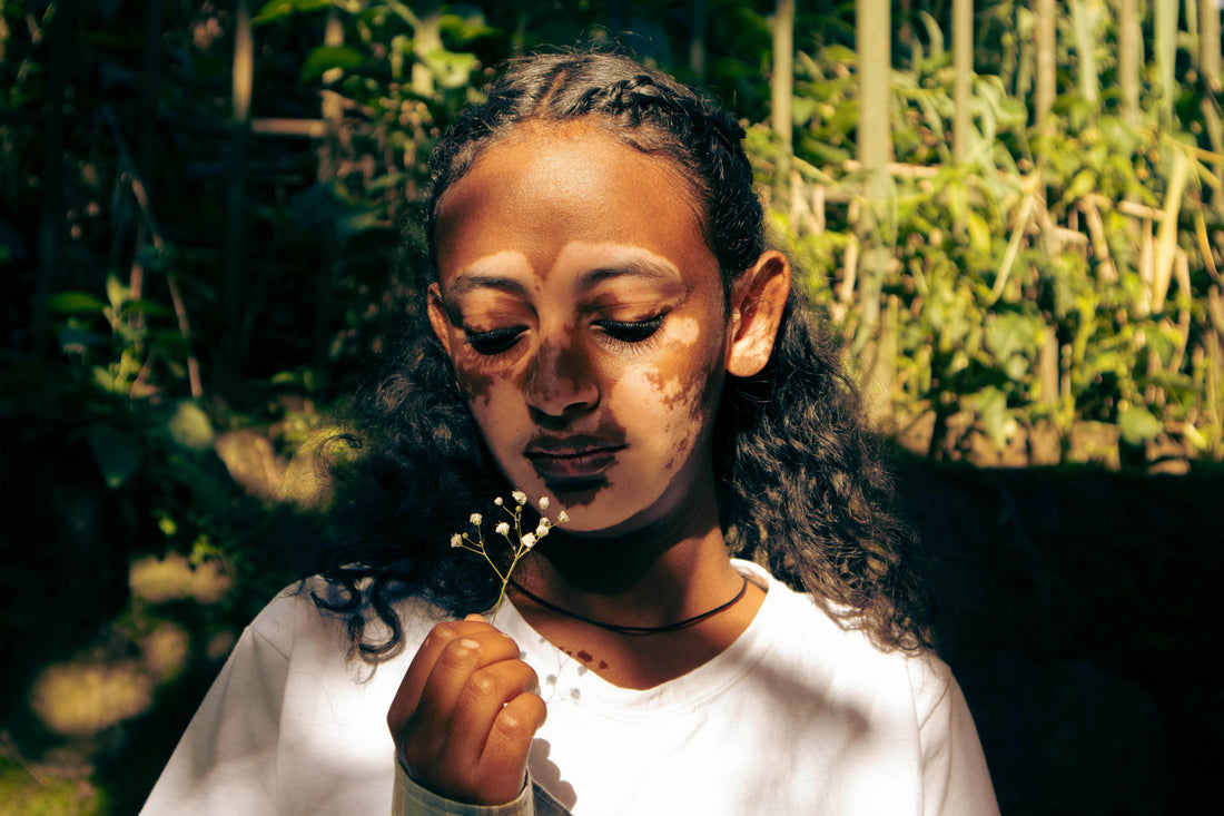 Mengenal Vitiligo: Penyakit Kulit yang Bukan Sekadar Perubahan Warna