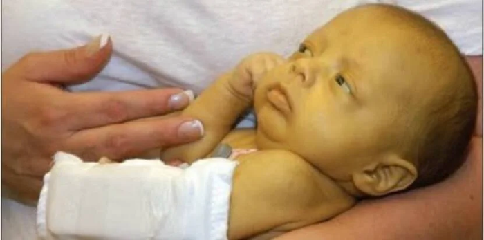 Ikterus Neonatorum: Saat Bayi Tampak Kuning di Hari-Hari Pertama