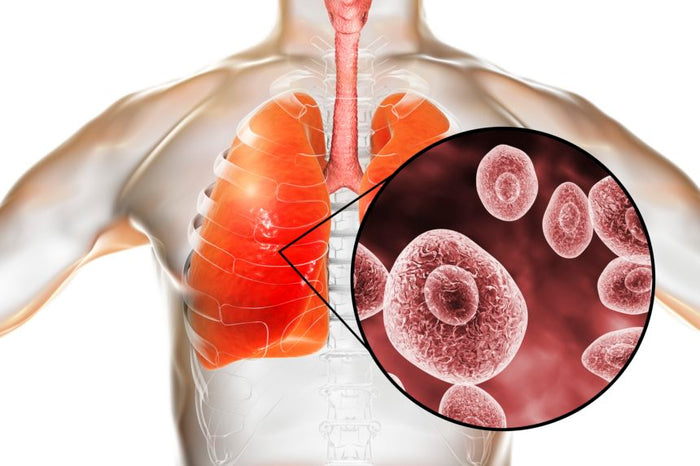 Virus Pneumonia yang Viral di Indonesia: Apa yang Harus Diketahui - Menteng Farma