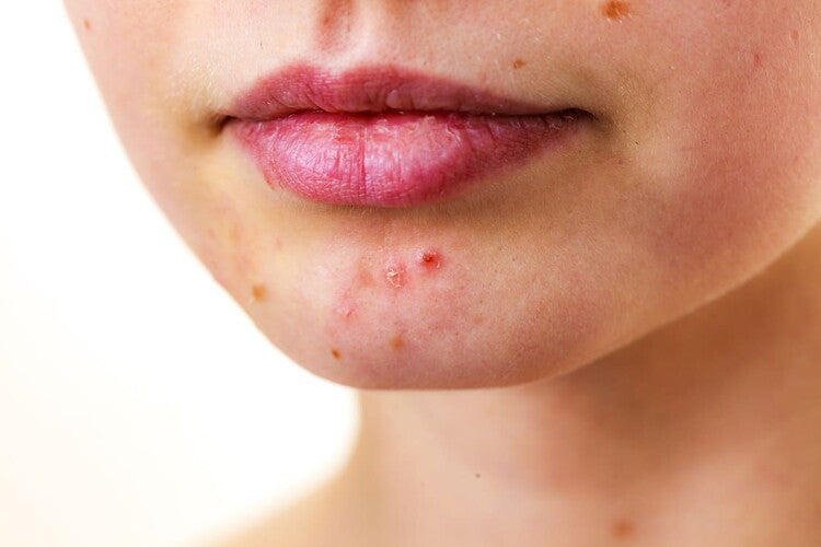 Fungal Acne: Jerawat Tapi Bukan Jerawat—Apa Bedanya dan Cara Mengobatinya